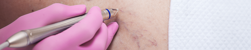 разширени капиляри