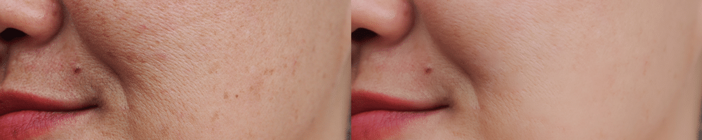 пигментни петна по лицето