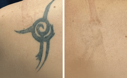 Премахване на татуировки и перманентен грим с Fotona StarWalker® Pico Pro FracTAT™