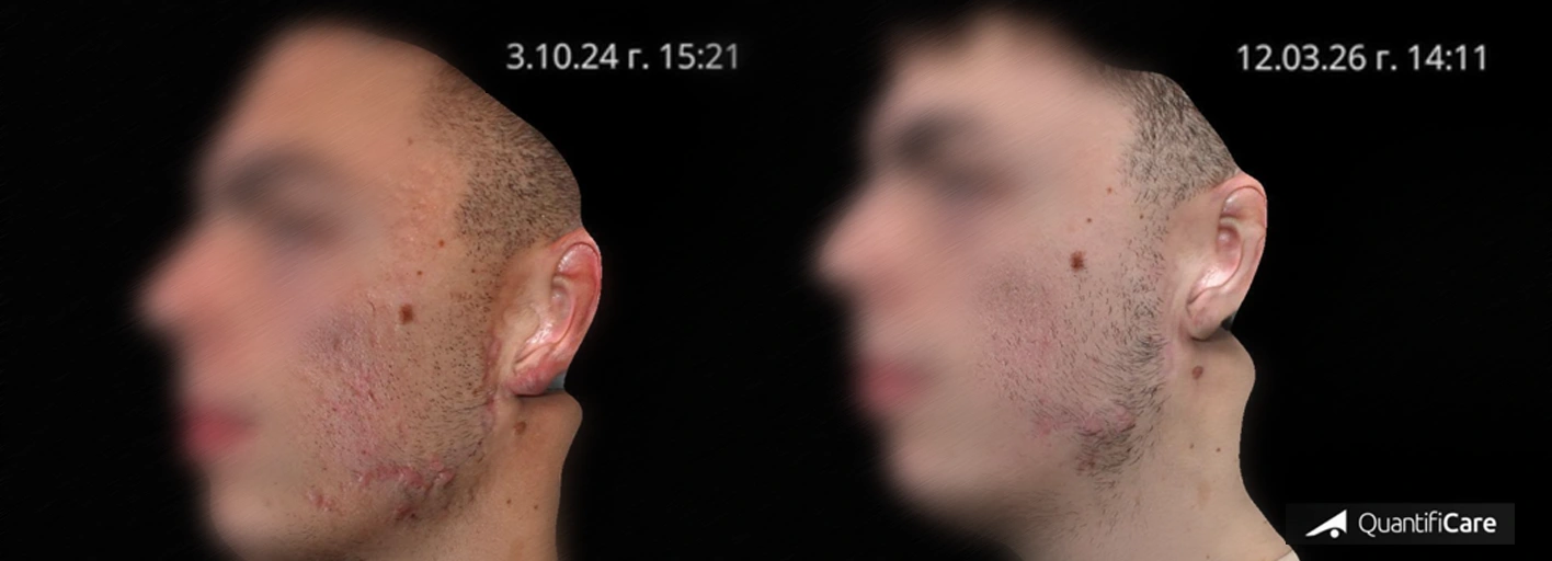 Преди и след лечение на акне и белези с фракционен CO2 лазер в клиника Дерма Вита