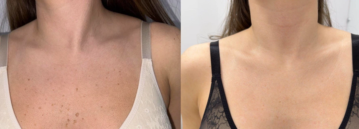 Преди и след премахване на пигментни петна по деколтето с Fotona Pico Pro и IPL в Дерма Вита