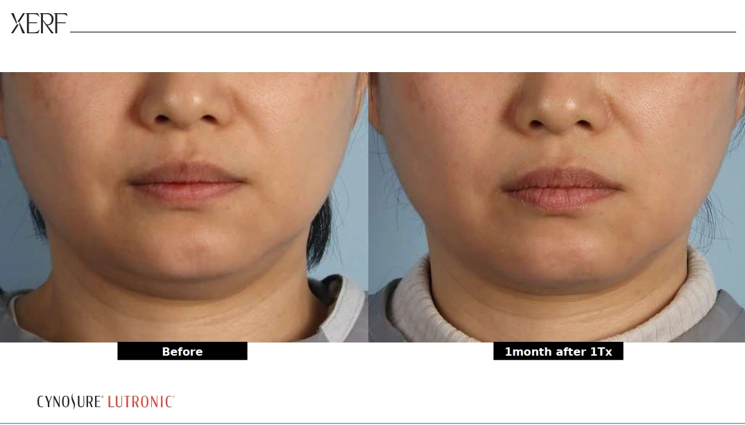 xerf derma vita